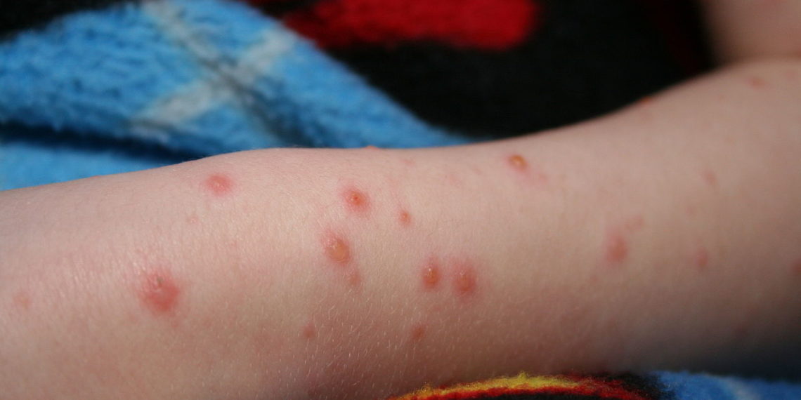 الحالات المشتبه بإصابتها بجدرى القرود في مونتريال لا تزال قيد التحقيق