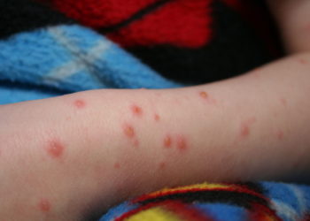 الحالات المشتبه بإصابتها بجدرى القرود في مونتريال لا تزال قيد التحقيق