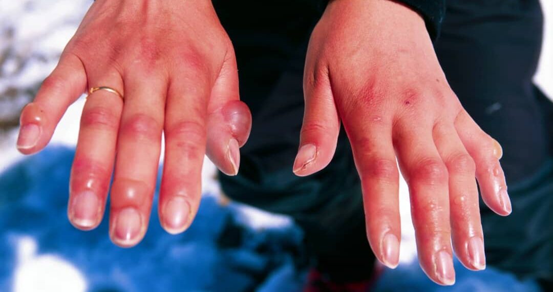 لسعة الصقيع أعراضها وطريقة الوقاية منها