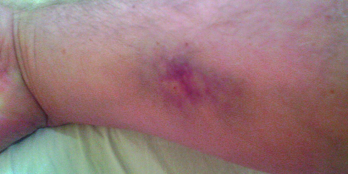 الصحة العامة في مونتريال تسجل 4 إصابات بمرض جلدي نادر