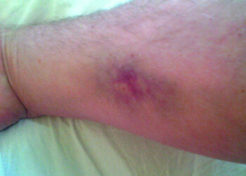 الصحة العامة في مونتريال تسجل 4 إصابات بمرض جلدي نادر