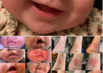 امرأة تشارك صوراً لطفلتها الرضيعة وتحذر من الإصابة بـ”التهاب الجلد النباتي”