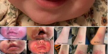 امرأة تشارك صوراً لطفلتها الرضيعة وتحذر من الإصابة بـ”التهاب الجلد النباتي”