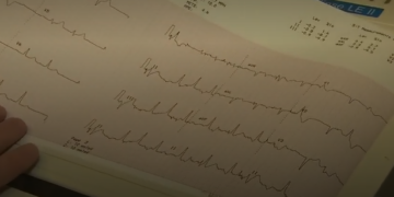 نقص دواء القلب dipyridamole في كندا سيؤدي إلى انتظار المرضى لفترة أطول
