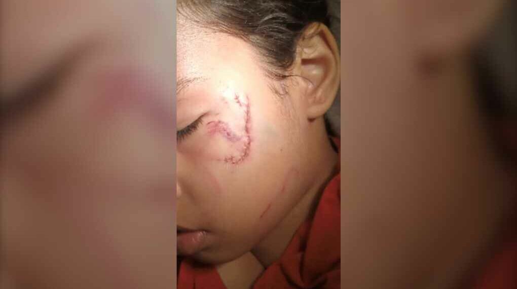 والدة طفلة صغيرة تعرضت للعض من كلب تطلب من المدينة تغيير لوائحها الداخلية