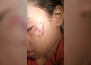 والدة طفلة صغيرة تعرضت للعض من كلب تطلب من المدينة تغيير لوائحها الداخلية