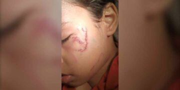 والدة طفلة صغيرة تعرضت للعض من كلب تطلب من المدينة تغيير لوائحها الداخلية